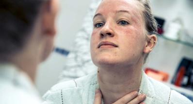 Looking for Volunteers with Eczema